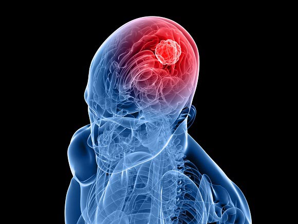 Brain Cancer Conditions And Treatments Singhealth